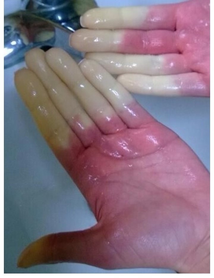 Color changes in the fingers are a common marker for Raynaud's Phenomenon